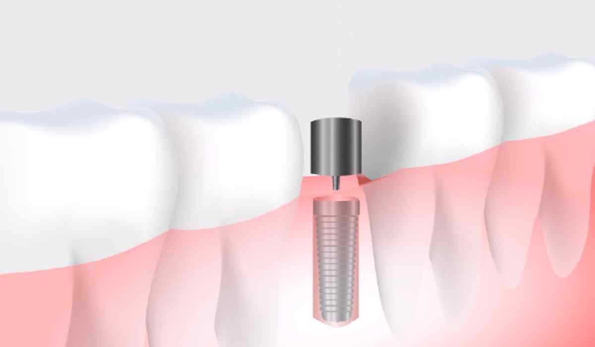 tab_image_01 https://clients-conceptsk8.com/dentistenapierville-home/wp-content/uploads/2023/05/tab_image_01.jpg